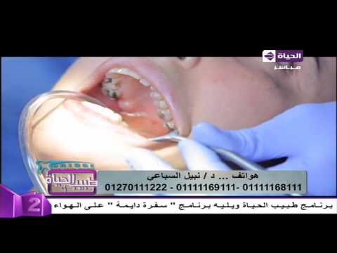 خطوات إجراء عملية زراعة الأسنان على أحد المرضى