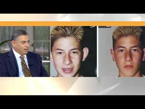 شاهد تخلص من مشكلة الأذن البارزة في أقل من نصف ساعة