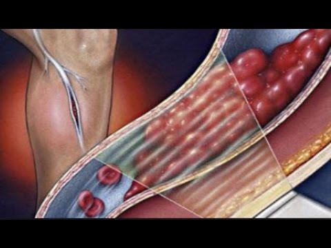 بالفيديو 4 علامات تحدد مدى تعرّض الشخص للإصابة بالجلطات