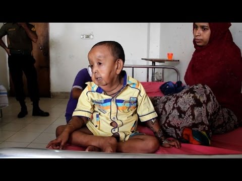 بالفيديو مرض غريب يجعل صبيًا في الرابعة من عمره في بنغلادش يبدو رجلًا عجوزًا