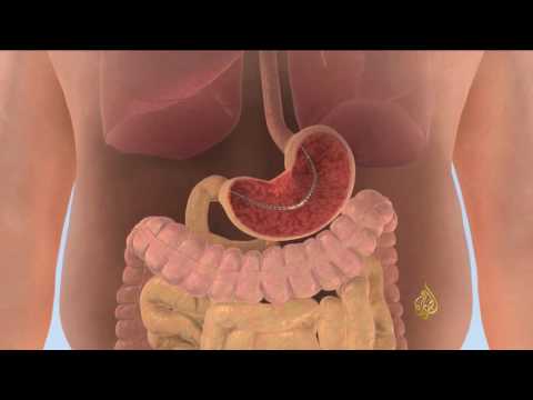 شاهد فادي دياب يستخدم تقنية حديثة لتصغير المعدة
