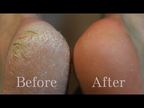 بالفيديو وصفة رائعة لتقشير الكعبين والتخلص من الجلد الميت