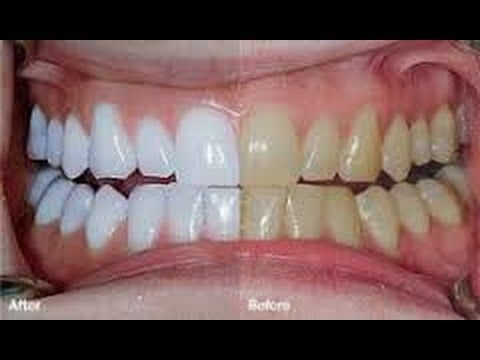 بالفيديو وصفة سحرية تمنحك أسنانا بيضاء كالثلج