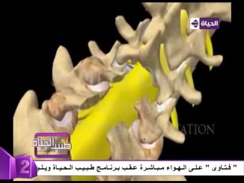 فيديو توضيحي لإجراء عملية في فقرات العمود الفقري