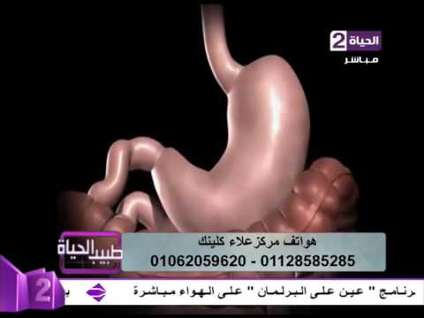 شاهد الفرق بين تكميم المعدة وتحويل المسار في المعدة