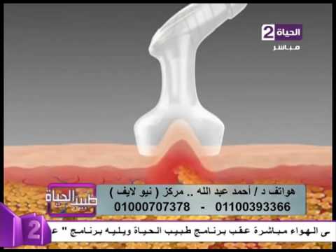 بالفيديو نتائج مبهرة فى شد ترهلات البطن