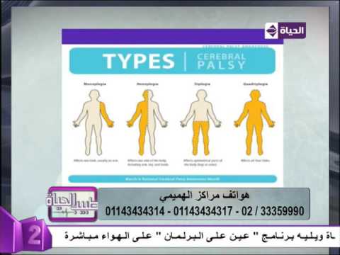 أشكال و أنواع الإصابة المخية  cp
