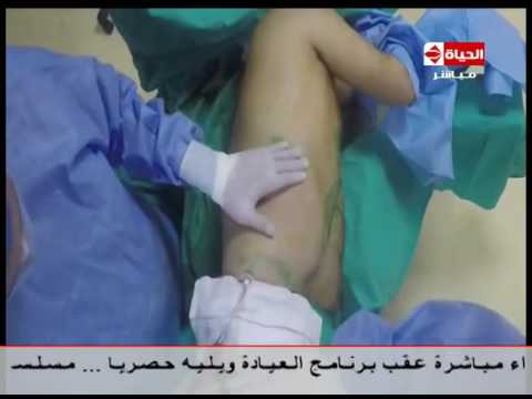 عملية النحت الديناميكي للدهون