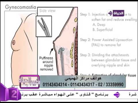 بالفيديو شرح عملية التخلص من التثدي لدى الرجال