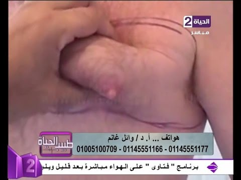 طريقة علاج ترهل الثدي عند الرجال