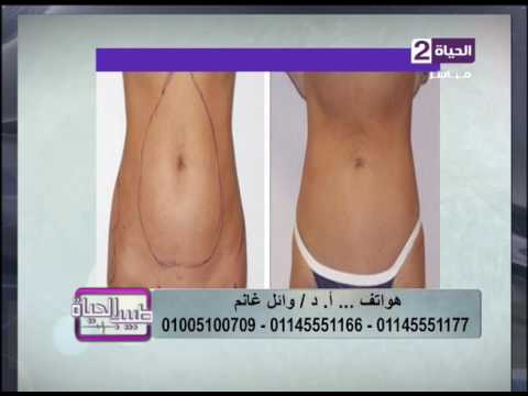 استشاري تجميل يُظهرنتائجًا مبهرة بعد شفط الدهون بالليزر