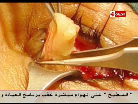 بالفيديو أسباب تكوّن الأكياس الدهنية تحت الجفن السفلي وكيفية علاجها