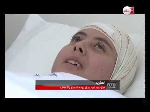 فريق طبي مغربي ينجح في فصل نصفي الدماغ لعلاج الصرع