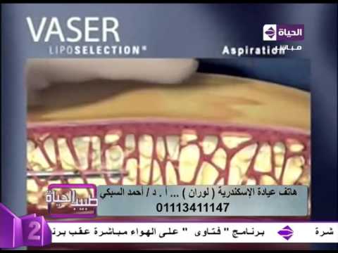 تفاصيل عملية شفط الدهون بالفيزر