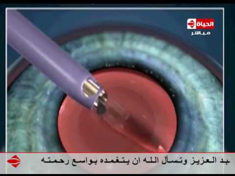 الدكتور ايهاب سعد يوضّح كيفية التخلص من عتامة القرنية