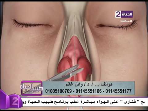 طريقة إجراء عملية جراحة تجميل الأنف