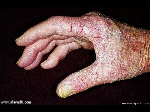 شاهد أفضل دواء لكزيما طبيًا وطبيعيًا