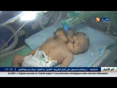 شاهد ولادة طفلة برأسين وجسد واحد