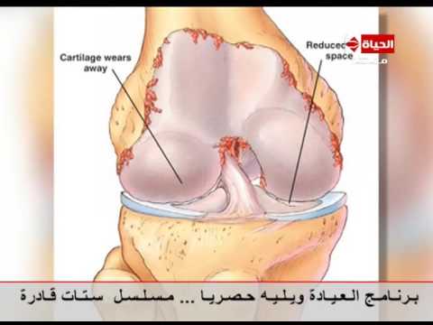 تعرف علي  أخطر الإصابات التى تحدث فى المفاصل وكيفية علاجها