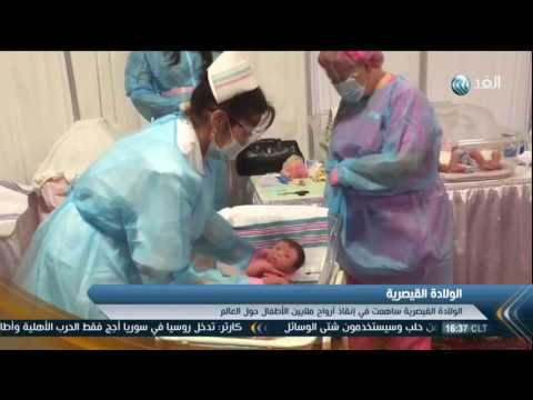 شاهد الولادة القيصرية تؤثّر على تطوّر البشر