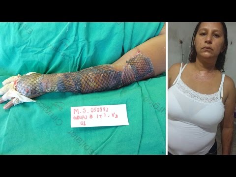 بالفيديو  علاج حروق سيدة باستخدام جلد الأسماك