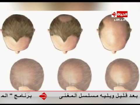 شاهد مرض الثعلبة ومدى خطورتها وكيفية علاجها