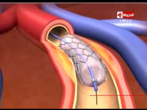 بالفيديو  الدكتور جمال شعبان يوضح كيفية تركيب الدعامة