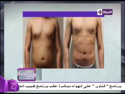 شاهد نتائج مبهرة بعد عملية الفيزر