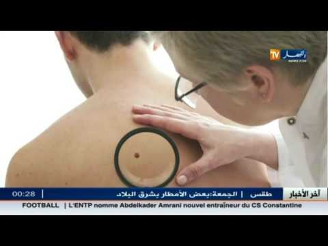 شاهد مرض البرص مع الدكتورة طلعة