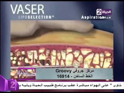 تعرّف على الفيزر وقدرته على تكسير الدهون وإستخلاصها من الجسم