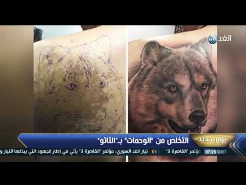 شاهد التخلص من الوحمات بـالتاتو