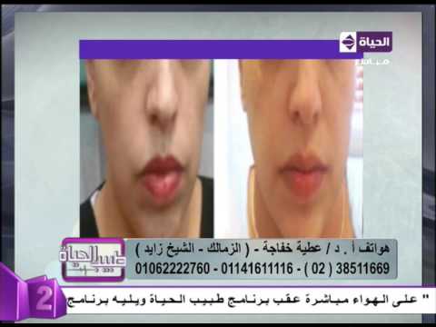 بالفيديو نتائح مبهرة بعد تجميل شكل الشفايف لدى النساء