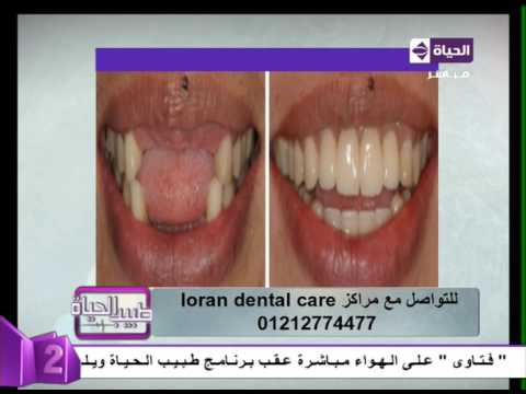 نتائج مبهرة بعد زراعة الأسنان