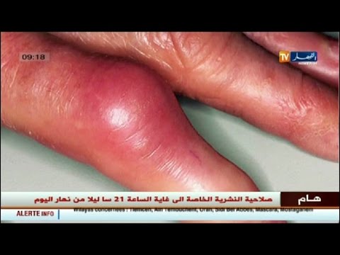 شاهد أسباب تورمات الأصابع