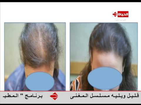 نتائج مبهرة بعد علاج الصلع الوراثي