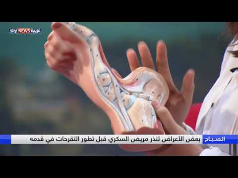 بالفيديو القدم السكرية المشكلة ومضاعفاتها