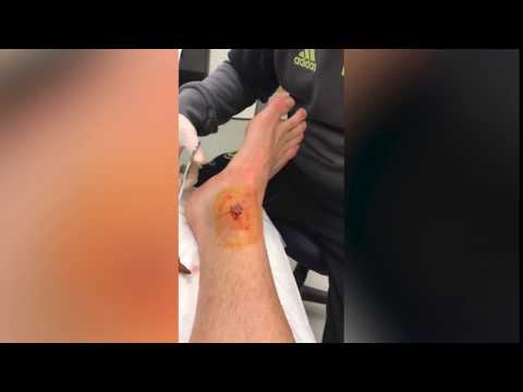 بالفيديو قائد تشيلسي يكشف سر غيابه عن مباراة بيرنلي