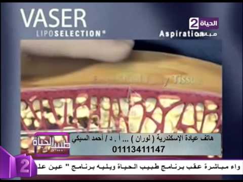 شاهد كيفية شفط الدهون بالفيزر