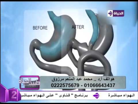 تفصاصيل عملية تحويل المسار المصغر ومضاعفاتها