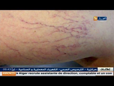 شاهد كيفية الوقاية من مرض التهاب الوريد