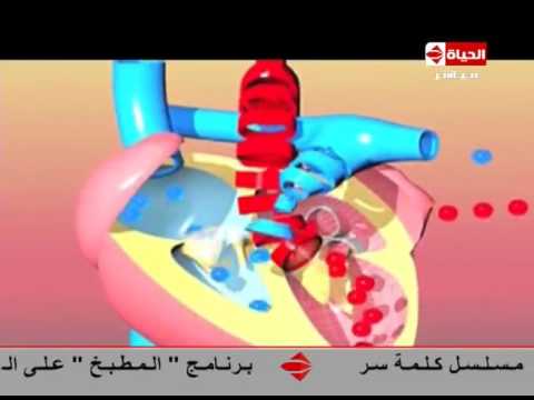 شاهد مقطع لثقب في القلب عند الأطفال وكيفية علاجه