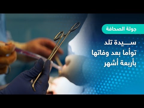 سيدة تلد توأمًا بعد وفاتها بأربعة أشهر في البرازيل