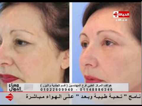 بالفيديو تعرفي على أنواع الخيوط لشد الوجه