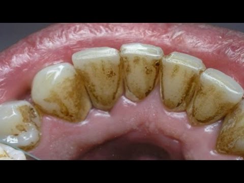 شاهد طريقة إزالة الرواسب البكتيرية من باطن الأسنان بطريقة سهلة