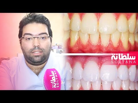أخصائي في تجميل الأسنان يكشف لك الخطوات ويحذر من المخاطر