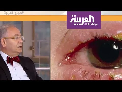 تعرف على كيفية علاج رمد العينين