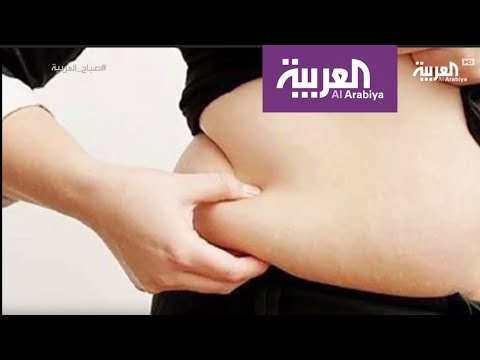 جراحة السمنة تتم للمريض إذا تجاوزت الزيادة 30 كلغ
