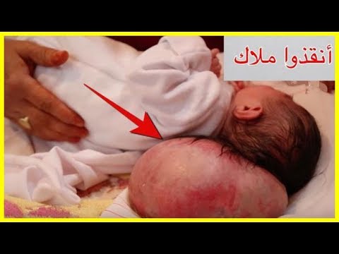 شاهد  ملاك  رضيعة برأسين تحتاج 18 مليون سنتيم للعلاج