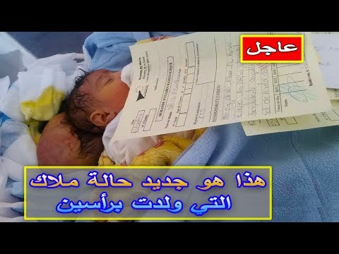 شاهد حالة ملاك التي ولدت برأسين