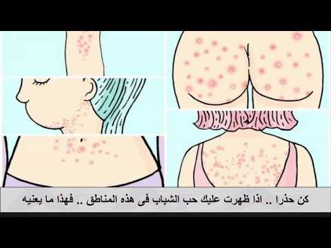 شاهد احذر  إذا ظهر عليك حب الشباب في هذه المناطق